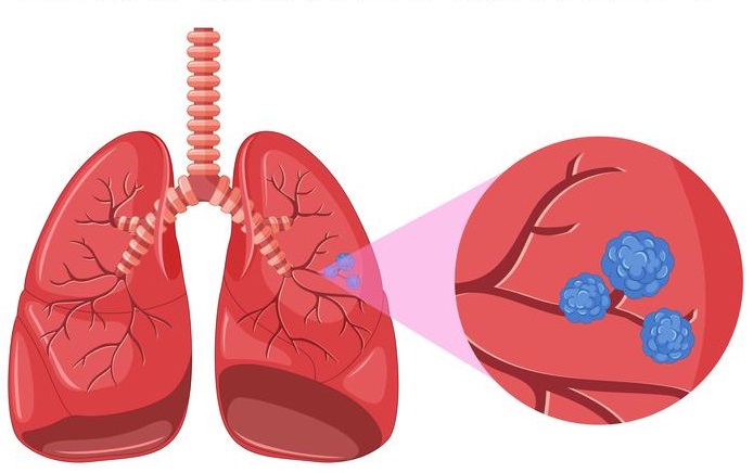 Lung Cancer Detection
